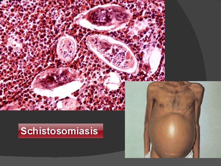 Schistosomiasis 