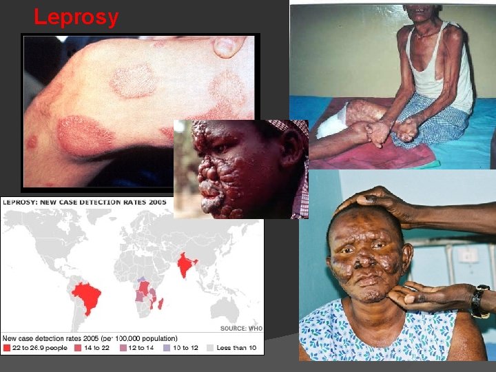 Leprosy 