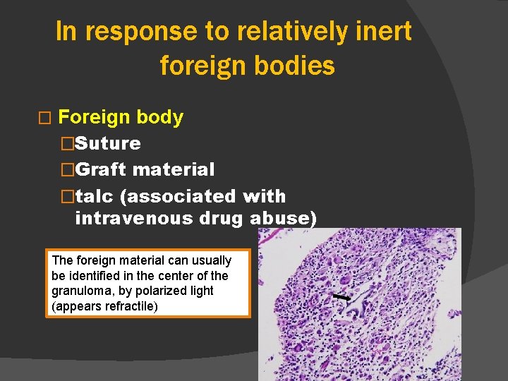 In response to relatively inert foreign bodies � Foreign body �Suture �Graft material �talc