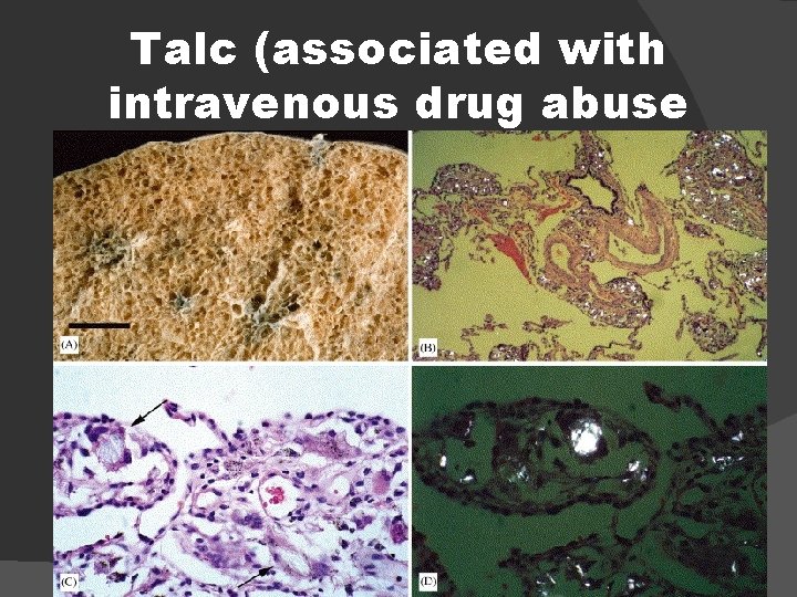 Talc (associated with intravenous drug abuse 