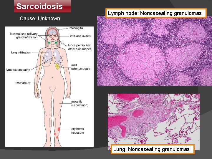 Sarcoidosis Cause: Unknown Lymph node: Noncaseating granulomas Lung: Noncaseating granulomas 