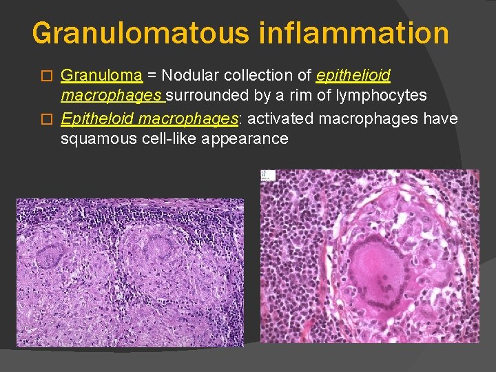 Granulomatous inflammation Granuloma = Nodular collection of epithelioid macrophages surrounded by a rim of