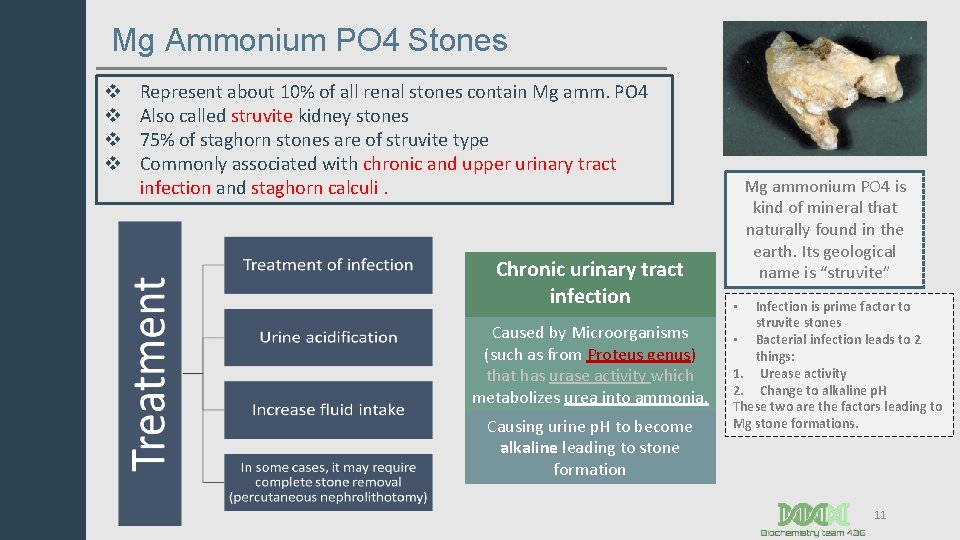 Mg Ammonium PO 4 Stones v v Represent about 10% of all renal stones