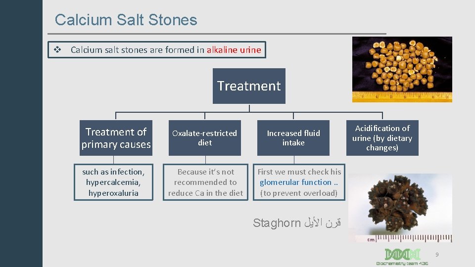 Calcium Salt Stones v Calcium salt stones are formed in alkaline urine Treatment of