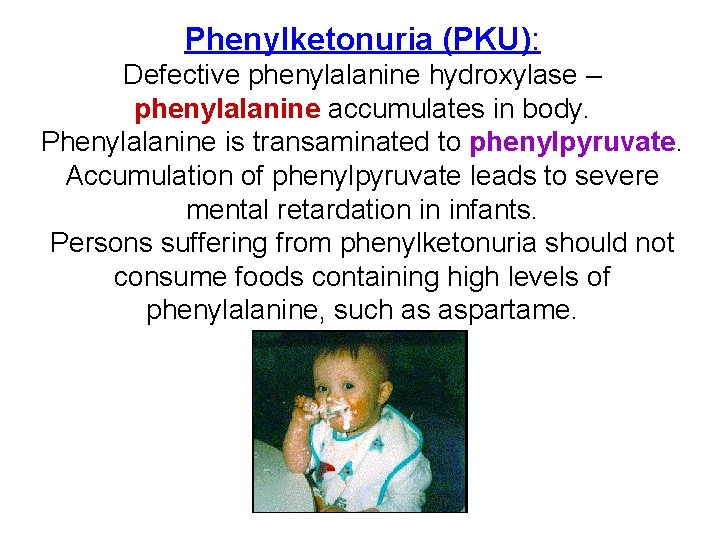 Phenylketonuria (PKU): Defective phenylalanine hydroxylase – phenylalanine accumulates in body. Phenylalanine is transaminated to