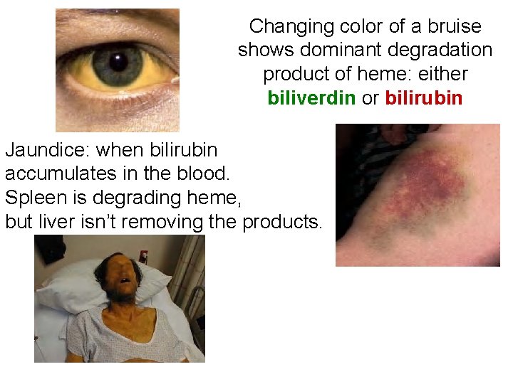 Changing color of a bruise shows dominant degradation product of heme: either biliverdin or