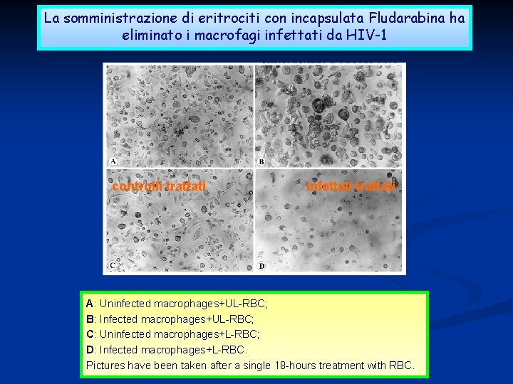 La somministrazione di eritrociti con incapsulata Fludarabina ha eliminato i macrofagi infettati da HIV-1