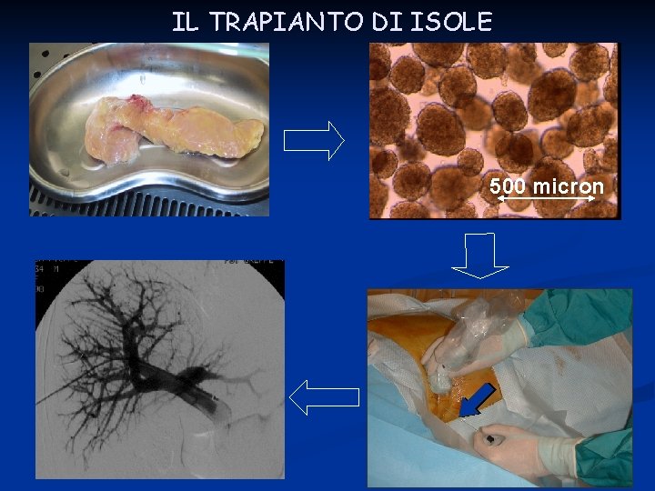 IL TRAPIANTO DI ISOLE 500 micron 