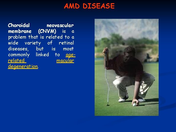 AMD DISEASE Choroidal neovascular membrane (CNVM) is a problem that is related to a