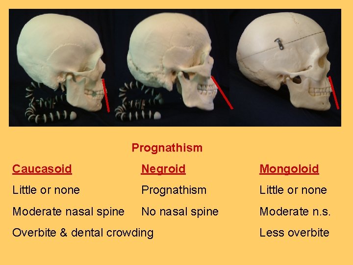  Prognathism Caucasoid Negroid Mongoloid Little or none Prognathism Little or none Moderate nasal