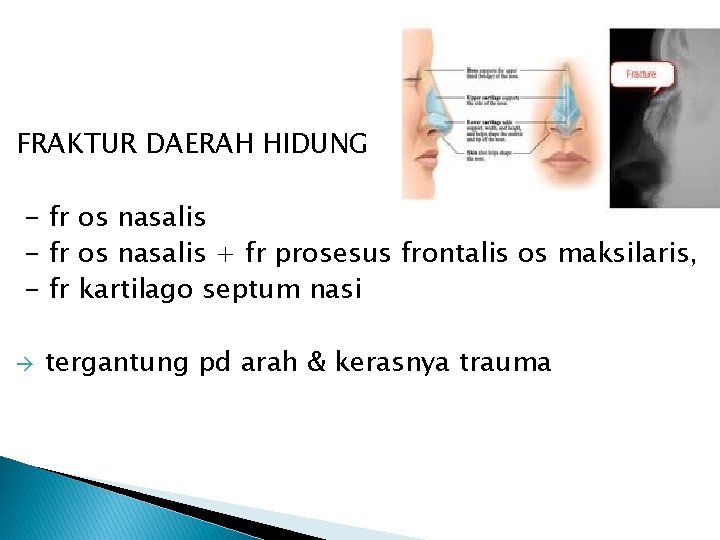 FRAKTUR DAERAH HIDUNG - fr os nasalis + fr prosesus frontalis os maksilaris, -
