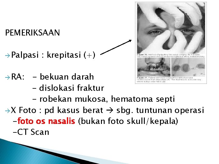 PEMERIKSAAN Palpasi RA: : krepitasi (+) - bekuan darah - dislokasi fraktur - robekan