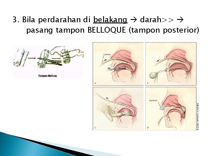 3. Bila perdarahan di belakang darah>> pasang tampon BELLOQUE (tampon posterior) 