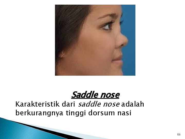 Saddle nose Karakteristik dari saddle nose adalah berkurangnya tinggi dorsum nasi 53 