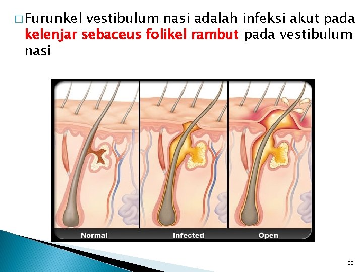 � Furunkel vestibulum nasi adalah infeksi akut pada kelenjar sebaceus folikel rambut pada vestibulum