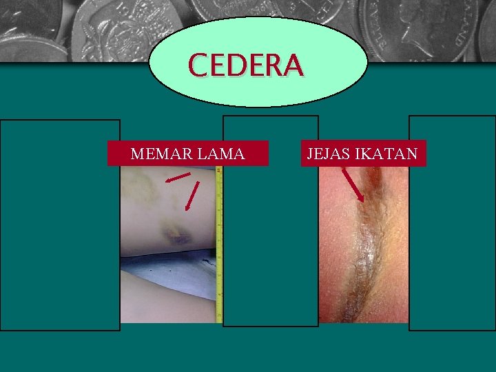 CEDERA MEMAR LAMA JEJAS IKATAN 