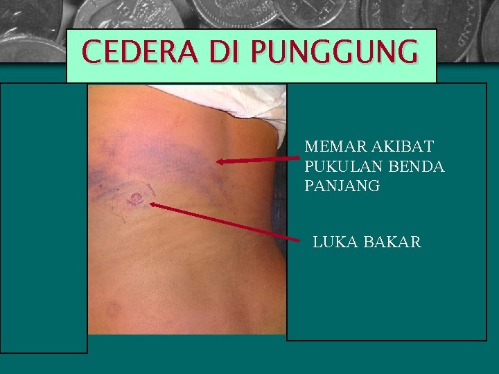 CEDERA DI PUNGGUNG MEMAR AKIBAT PUKULAN BENDA PANJANG LUKA BAKAR 