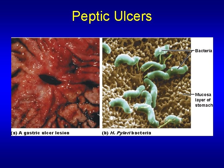 Peptic Ulcers Bacteria Mucosa layer of stomach (a) A gastric ulcer lesion (b) H.