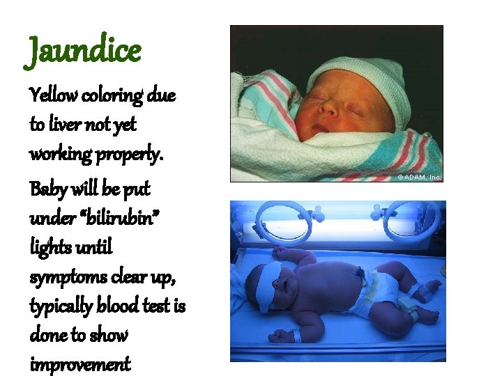 Jaundice Yellow coloring due to liver not yet working properly. Baby will be put