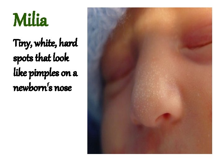 Milia Tiny, white, hard spots that look like pimples on a newborn's nose 