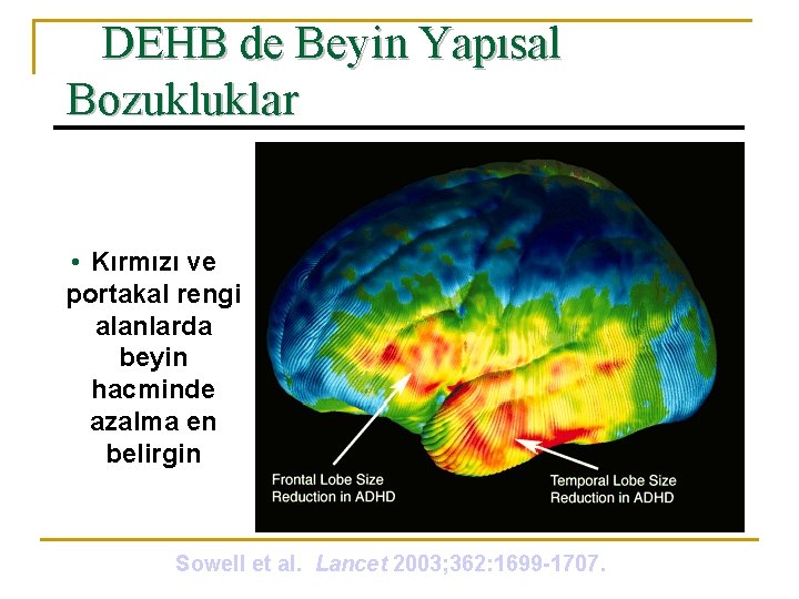 DEHB de Beyin Yapısal Bozukluklar • Kırmızı ve portakal rengi alanlarda beyin hacminde azalma