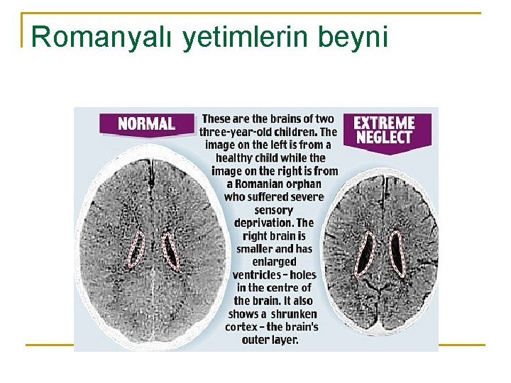 Romanyalı yetimlerin beyni 