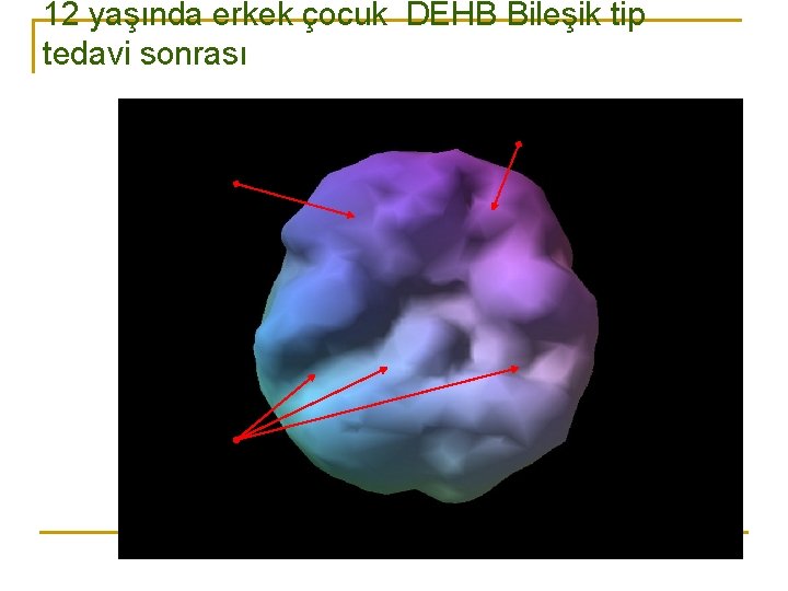 12 yaşında erkek çocuk DEHB Bileşik tip tedavi sonrası 