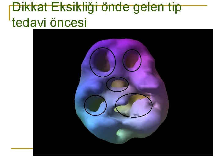 Dikkat Eksikliği önde gelen tip tedavi öncesi 