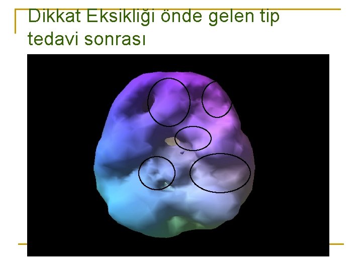 Dikkat Eksikliği önde gelen tip tedavi sonrası 