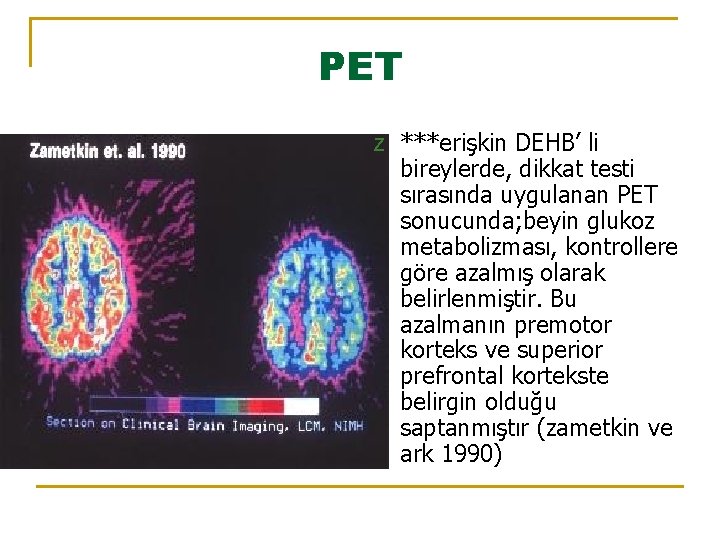 PET z ***erişkin DEHB’ li bireylerde, dikkat testi sırasında uygulanan PET sonucunda; beyin glukoz