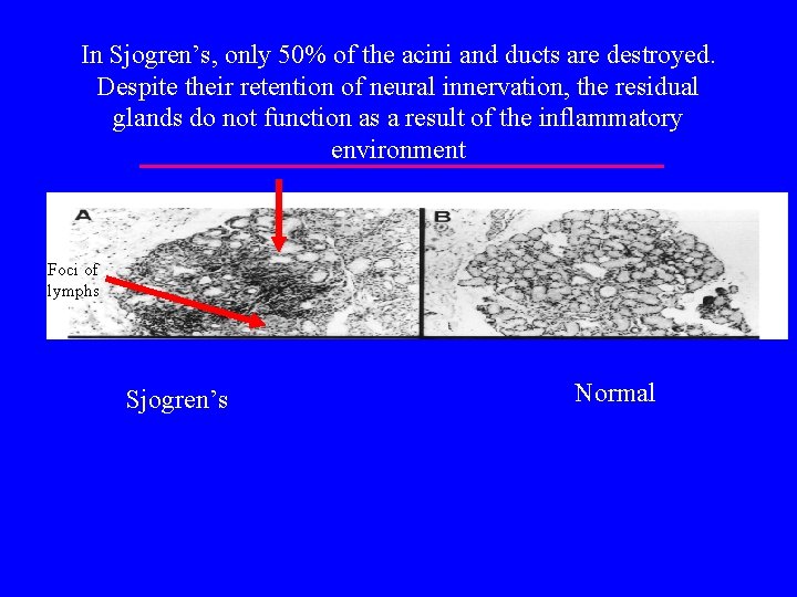 In Sjogren’s, only 50% of the acini and ducts are destroyed. Despite their retention