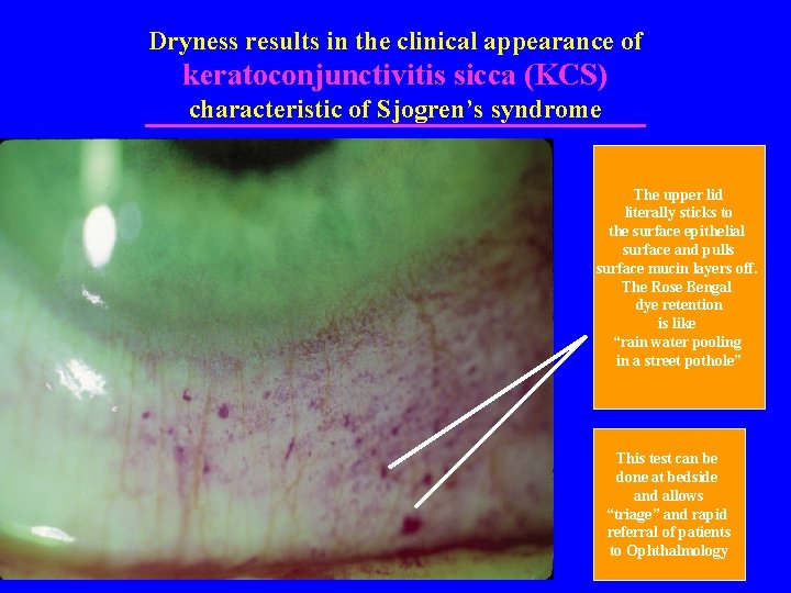 Dryness results in the clinical appearance of keratoconjunctivitis sicca (KCS) characteristic of Sjogren’s syndrome