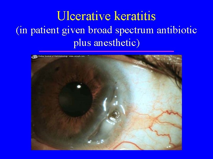 Ulcerative keratitis (in patient given broad spectrum antibiotic plus anesthetic) 
