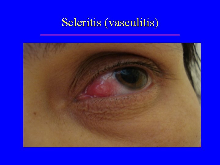 Scleritis (vasculitis) 