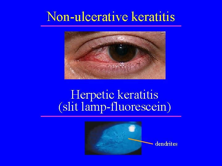Non-ulcerative keratitis Herpetic keratitis (slit lamp-fluorescein) dendrites 
