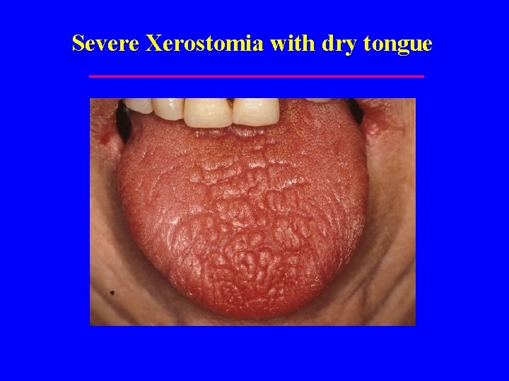 Severe Xerostomia with dry tongue 