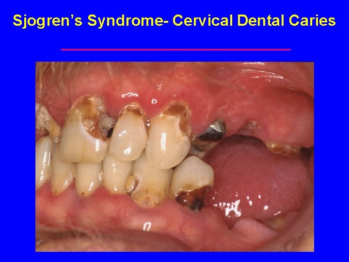 Sjogren’s Syndrome- Cervical Dental Caries 