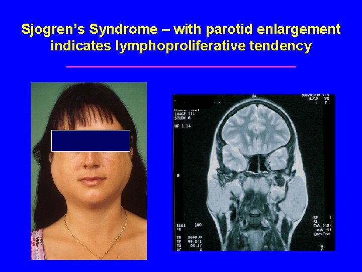 Sjogren’s Syndrome – with parotid enlargement indicates lymphoproliferative tendency 