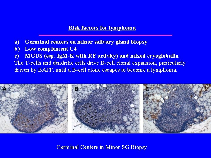 Risk factors for lymphoma a) Germinal centers on minor salivary gland biopsy b) Low