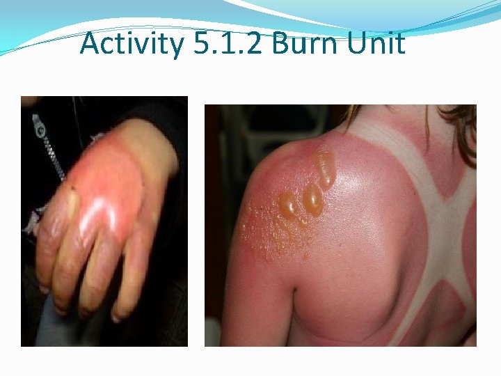 Activity 5. 1. 2 Burn Unit 