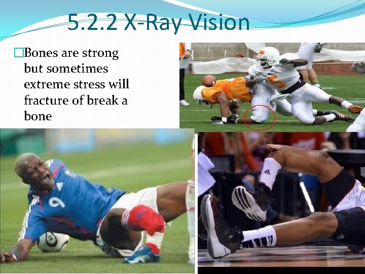 5. 2. 2 X-Ray Vision �Bones are strong but sometimes extreme stress will fracture
