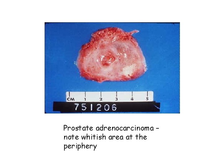Prostate adrenocarcinoma – note whitish area at the periphery 