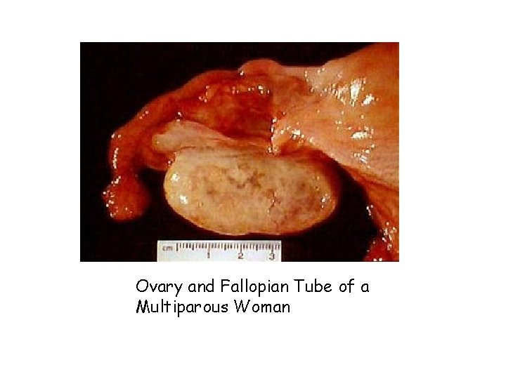 Ovary and Fallopian Tube of a Multiparous Woman 