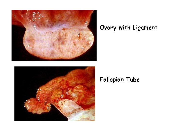 Ovary with Ligament Fallopian Tube 