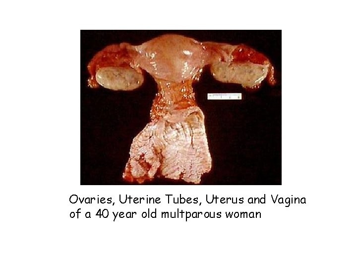 Ovaries, Uterine Tubes, Uterus and Vagina of a 40 year old multparous woman 