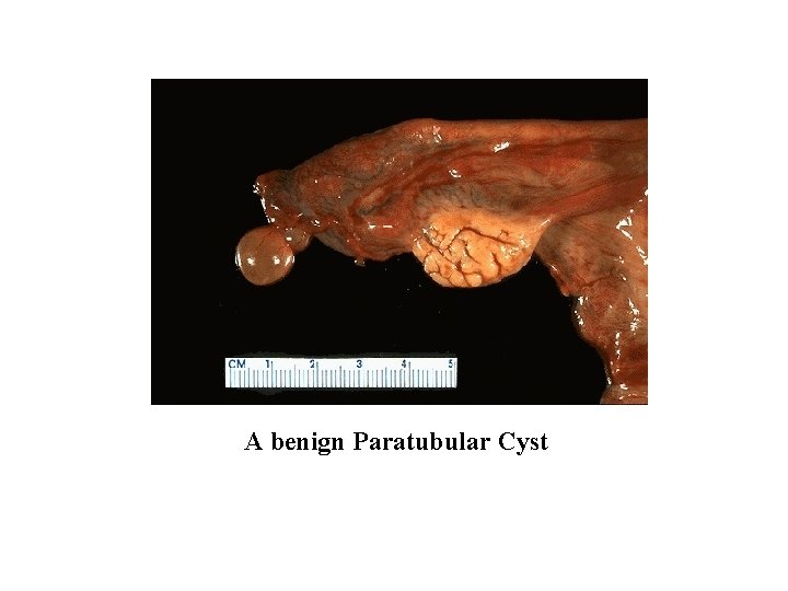 A benign Paratubular Cyst 