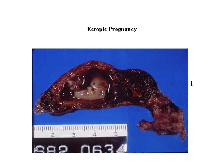Ectopic Pregnancy 1 