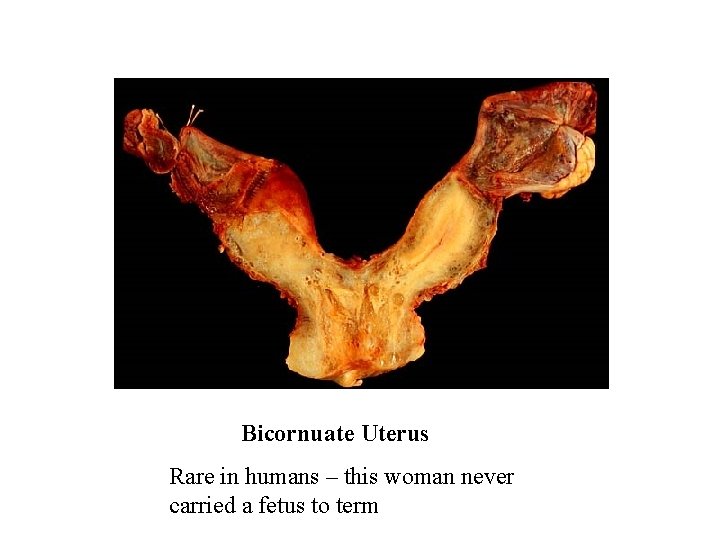 Bicornuate Uterus Rare in humans – this woman never carried a fetus to term
