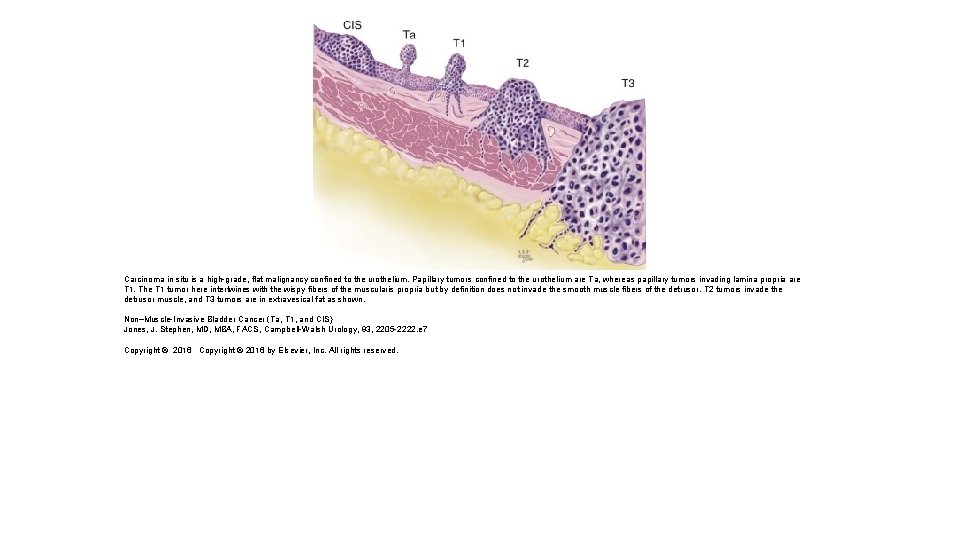 Carcinoma in situ is a high-grade, flat malignancy confined to the urothelium. Papillary tumors