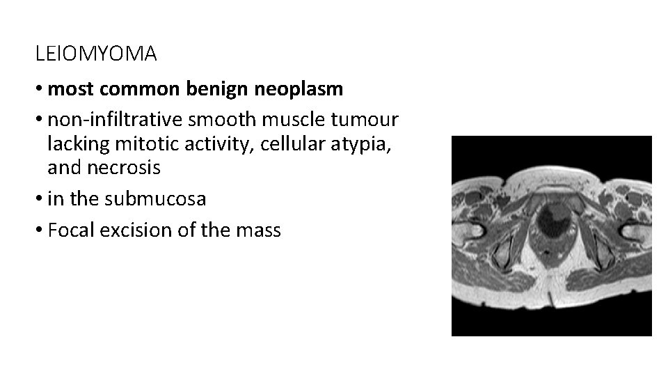 LEIOMYOMA • most common benign neoplasm • non-infiltrative smooth muscle tumour lacking mitotic activity,